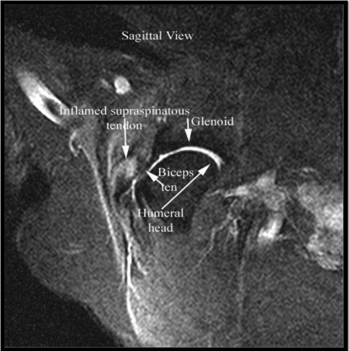 Supraspinatus Tendinopathy in 327 Dogs A Retrospective Study Canapp