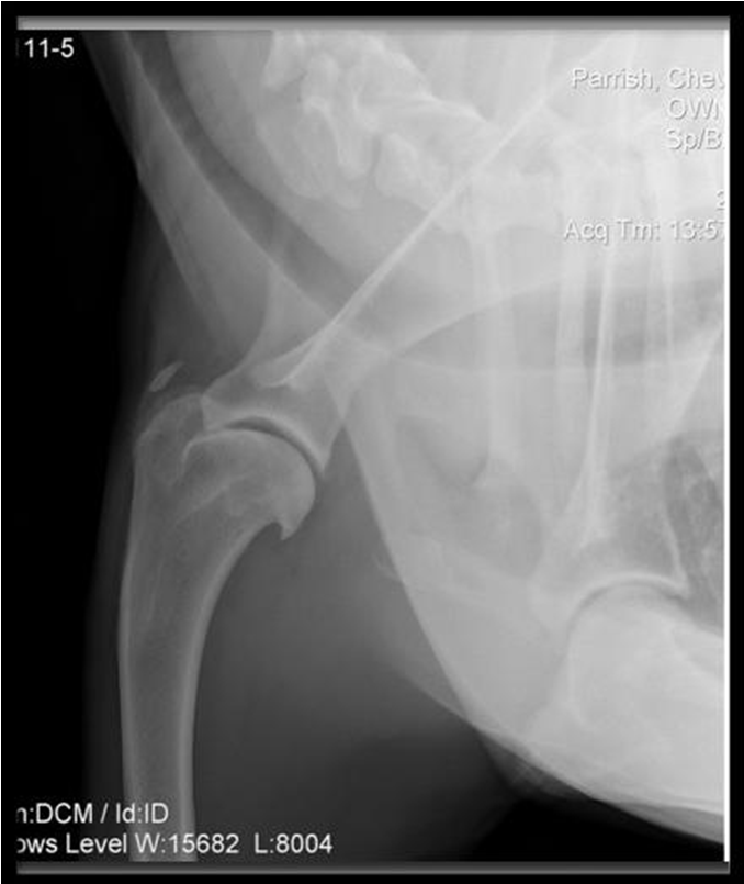 Shoulder radiograph with mineralisation of the supraspinatus tendon insertion